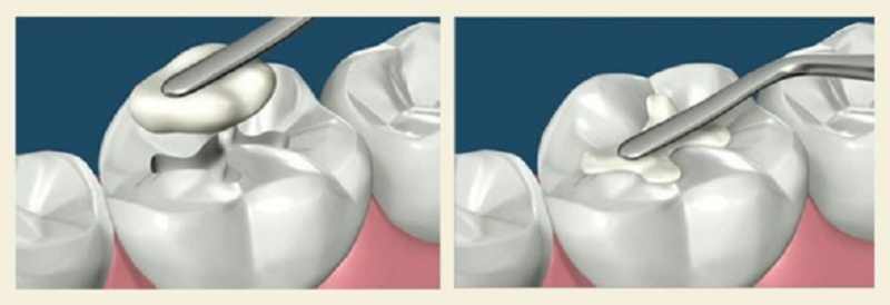 دندانپزشکی ترمیمی و مراحل ترمیم دندان